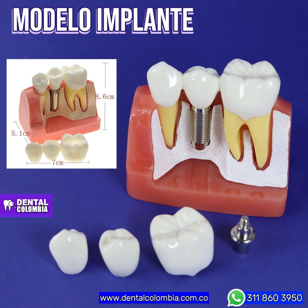 MODELO DE IMPLANTES Y CORONAS