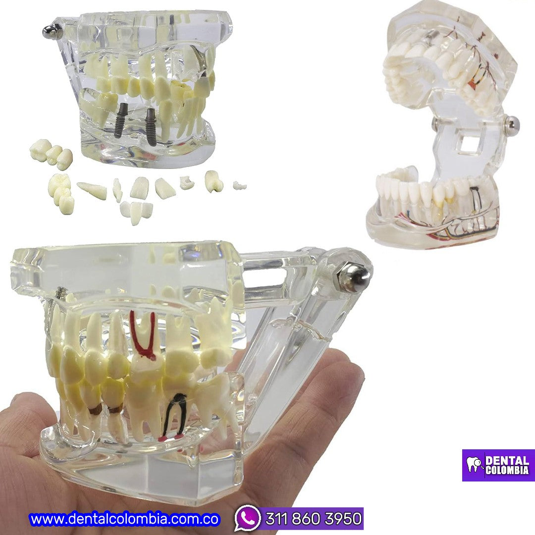 MODELO DE IMPLANTE Y ENFERMEDADES