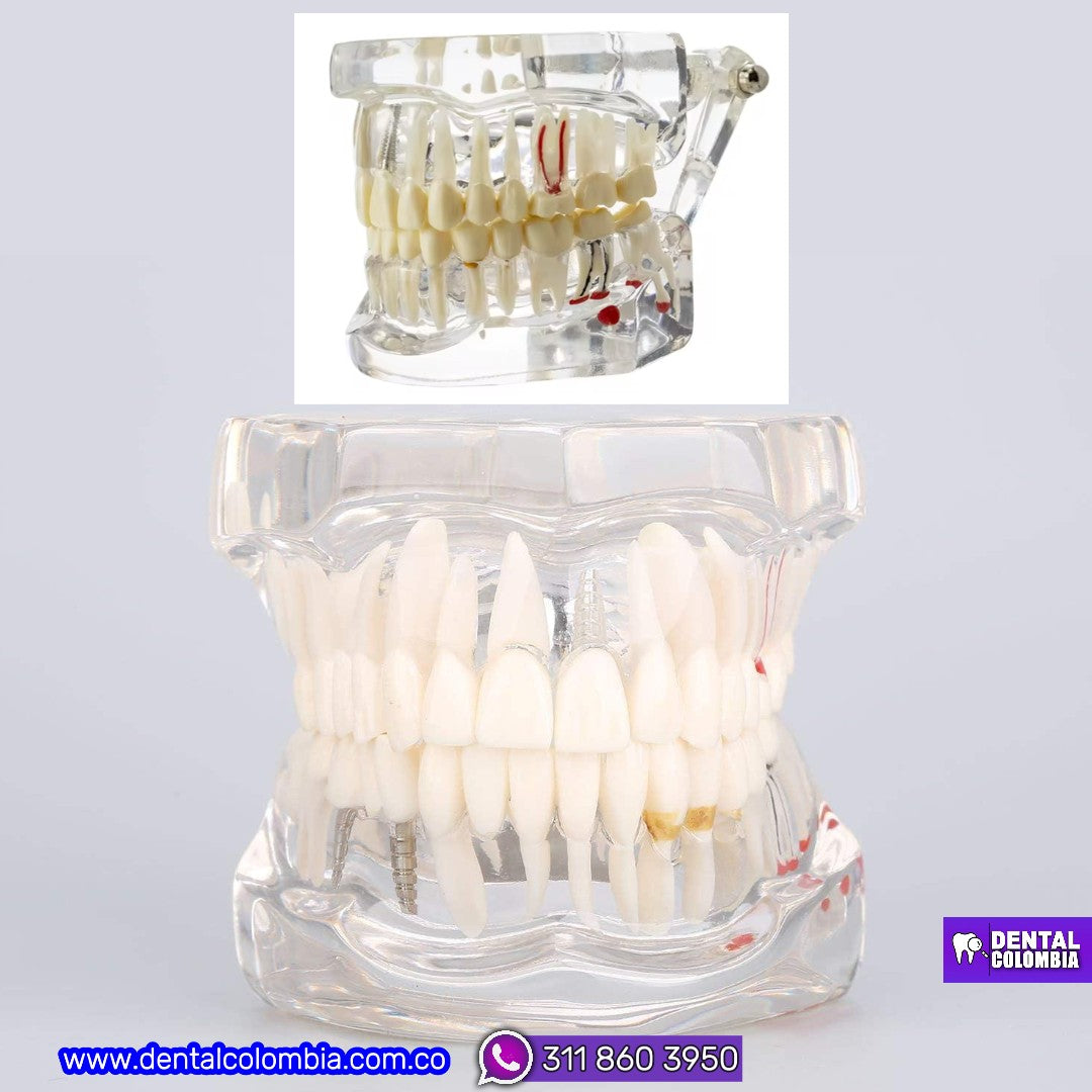 MODELO DE IMPLANTE Y ENFERMEDADES