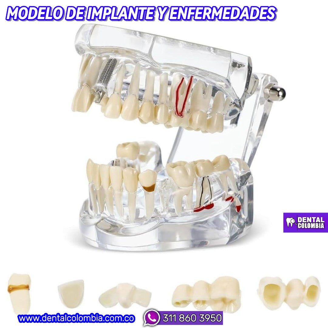 MODELO DE IMPLANTE Y ENFERMEDADES